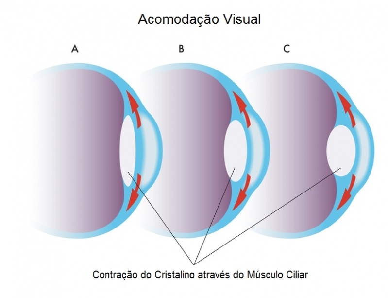 Cirurgia de Calázio Pacaembu - Cirurgia de Pterígio