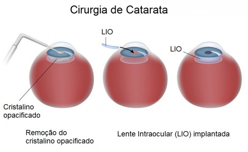 Cirurgia de Catarata Preço Pirituba - Cirurgia Ocular em Sp