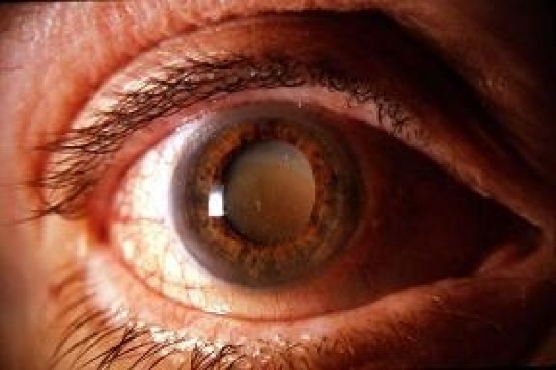 Cirurgia de Pterígio Jardim São Luiz - Cirurgia Plástica Ocular