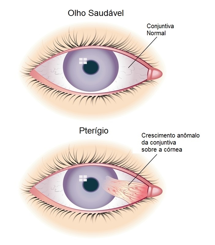 Cirurgia Ocular de Pterígio Cidade Tiradentes - Cirurgia de Calázio