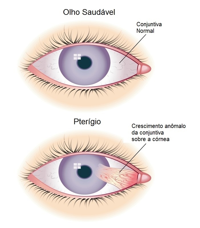 Cirurgia Ocular de Pterígio Artur Alvim - Cirurgia de Ocular no Paraíso