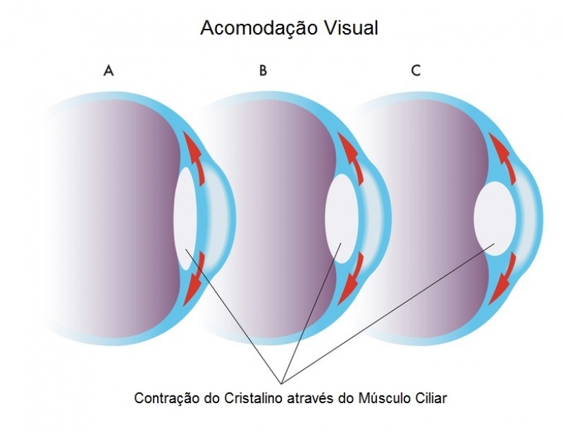 Cirurgia Ocular Aricanduva - Cirurgia para Astigmatismo