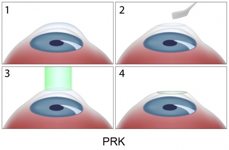 Cirurgia para Hipermetropia Preço na Bela Vista - Cirurgia Plástica Ocular