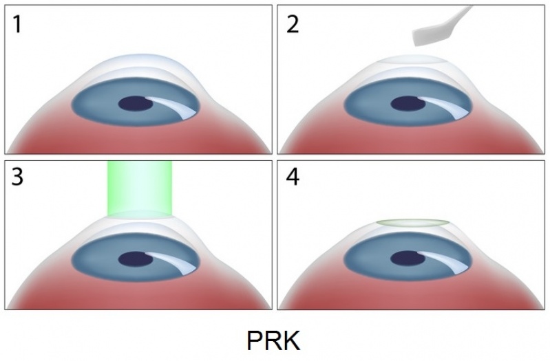 Cirurgia para Hipermetropia Preço Brooklin - Cirurgia para Hipermetropia