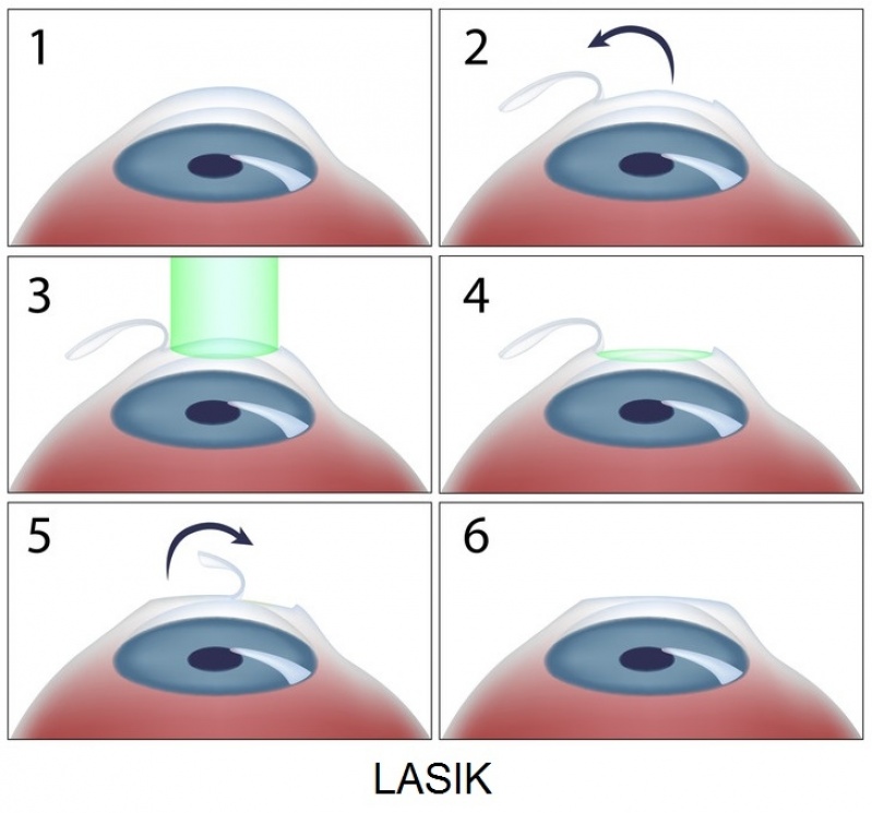 Cirurgia para Hipermetropia Jaraguá - Cirurgia Plástica Ocular