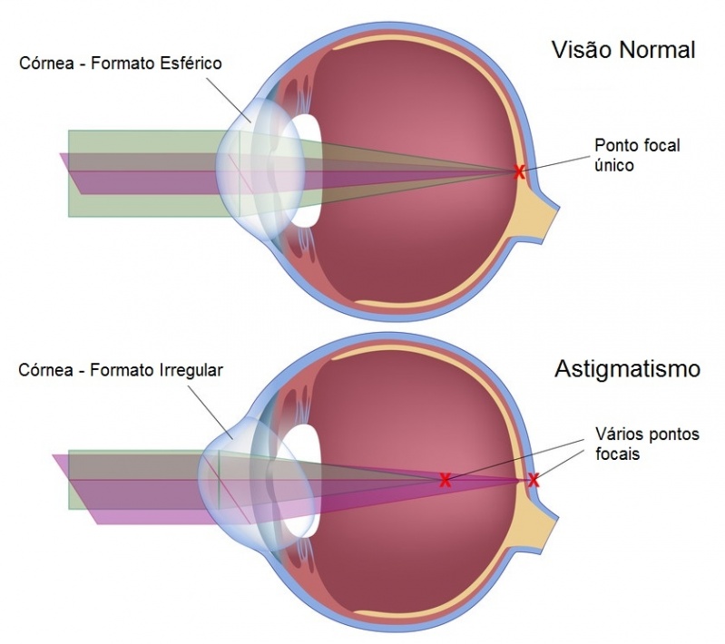 Cirurgia para Implante de Lente Intra Ocular na Santa Cecília - Cirurgia Plástica Ocular