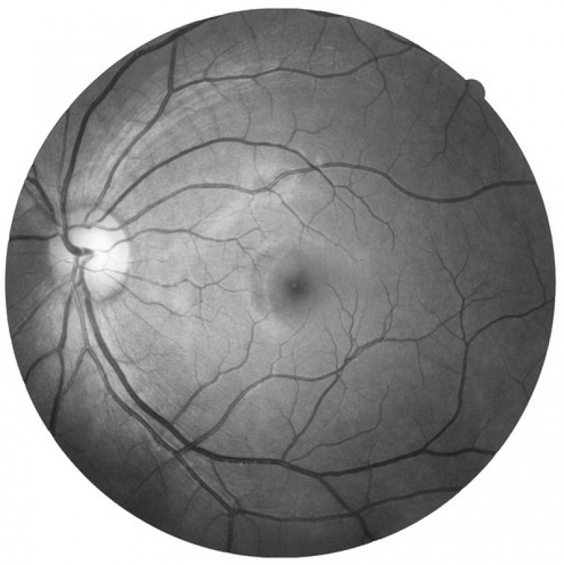 Exame de Campimetria Ocular na Aclimação - Exame de Retinografia