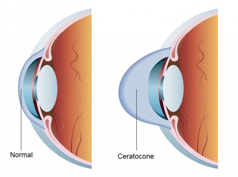 Médico Oftalmologista Sp Tatuapé - Médico Especialista em Catarata