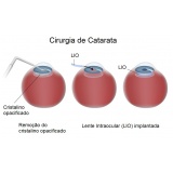 cirurgia de catarata preço Jaguaré