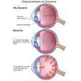 cirurgia de crosslinking Itaim Paulista