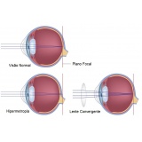 cirurgia de iridectomia na Luz