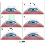 cirurgia ocular de catarata Lapa