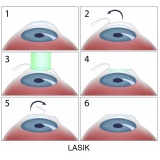 cirurgia ocular de catarata na Consolação