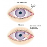 cirurgia ocular de pterígio Jockey Club