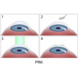 cirurgia para hipermetropia preço Brooklin