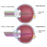 cirurgia para implante de lente intra ocular Brooklin