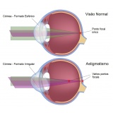 cirurgia para implante de lente intra ocular Vila Carrão