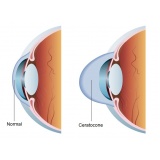 oftalmologista catarata Glicério