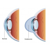 oftalmologista para cirurgia de anel de ferrara