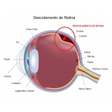 tratamento para catarata Lapa