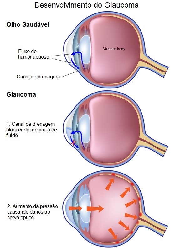 Tratamento de Ametropia Jardim Bonfiglioli - Tratamento para Glaucoma