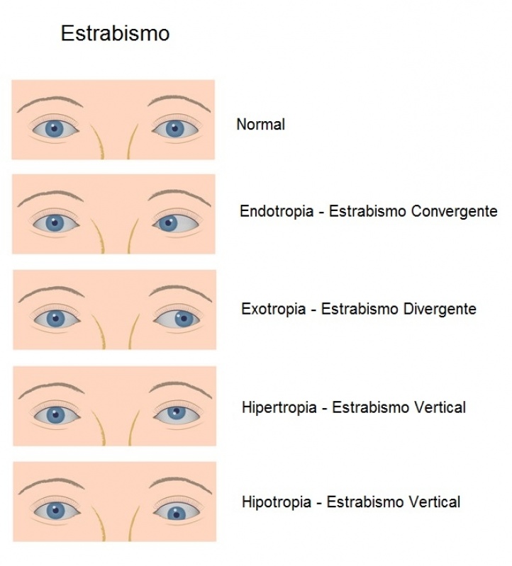 Tratamento de Doenças Oculares Quanto Custa José Bonifácio - Tratamento para Miopia