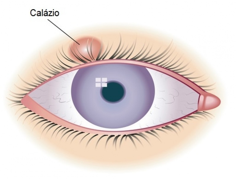 Tratamento Miopia Ponte Rasa - Tratamento para Glaucoma em Sp