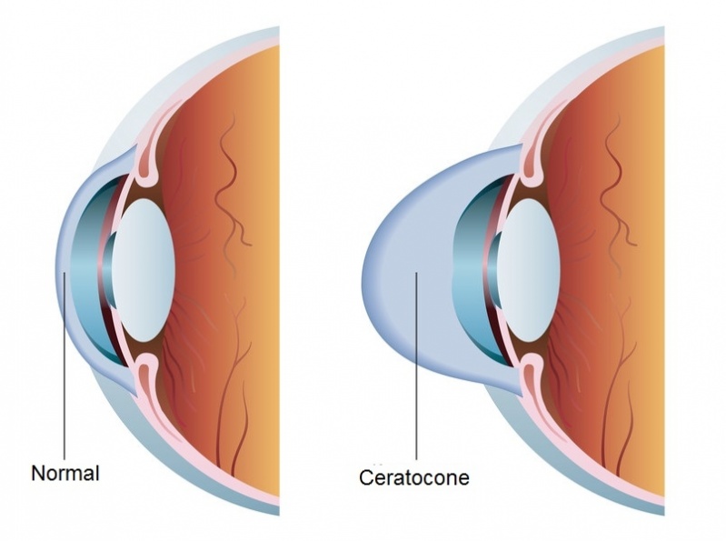 Tratamento Oftalmológico Quanto Custa na Pari - Tratamento para Glaucoma em Sp