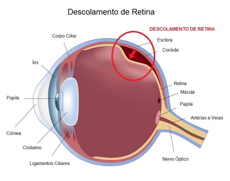 Tratamento para Catarata Campo Limpo - Tratamento Oftalmológico