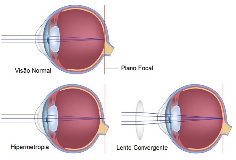 Tratamento para Presbiopia Jardim Paulistano - Tratamento para Ametropia